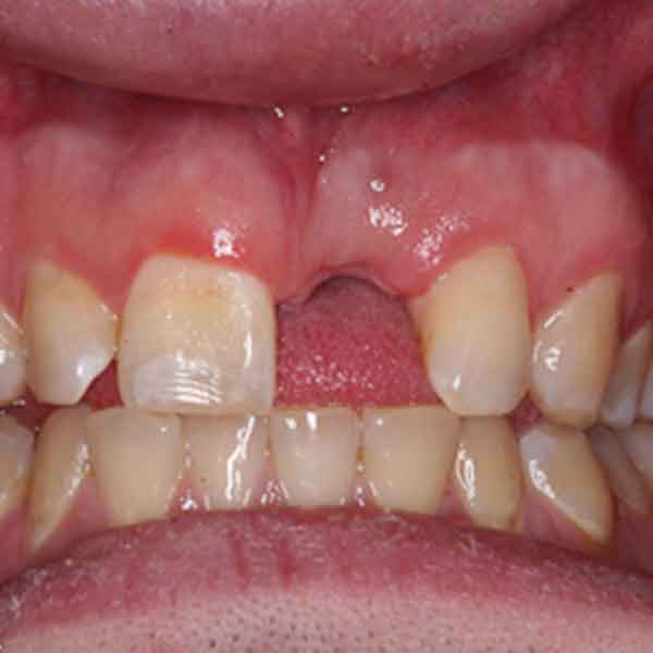 Ridge Augmentation and Guided Bone Regeneration North Texas Dental