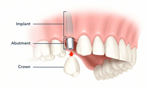 chart showing a dental implant