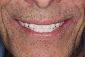 All-on-4 implant denture patient after