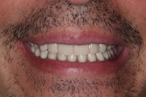 All-on-4 implant denture after