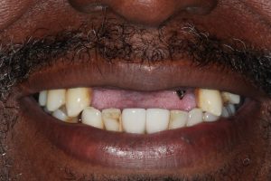 All-on-4 implant denture patient before