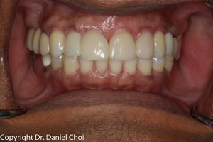 Dental Implant results