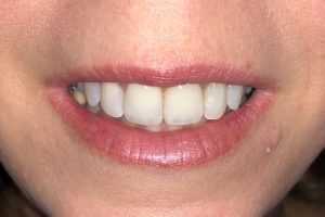 Dental Implant results