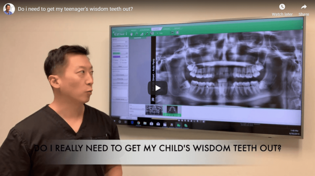 How Long Does Numbness Last After Wisdom Teeth Removal? North Texas