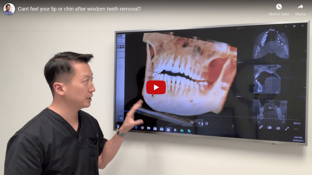 How Long Does Numbness Last After Wisdom Teeth Removal? North Texas Dental Surgery