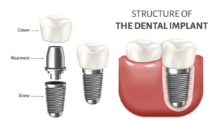 Structure of Dental Implant