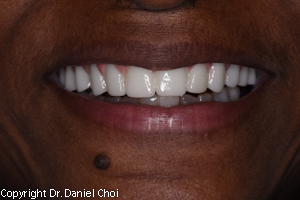 Snap in denture after