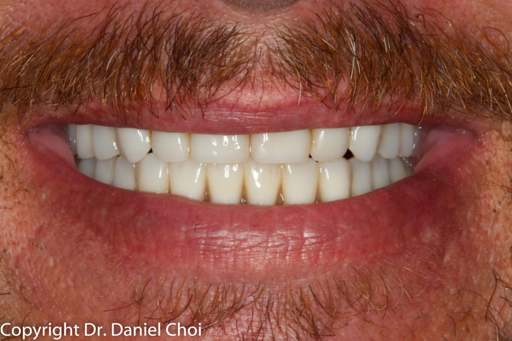 All on 4 North Texas Dental Surgery