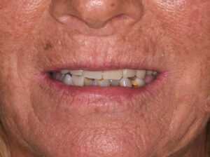 Implant Dentures Before