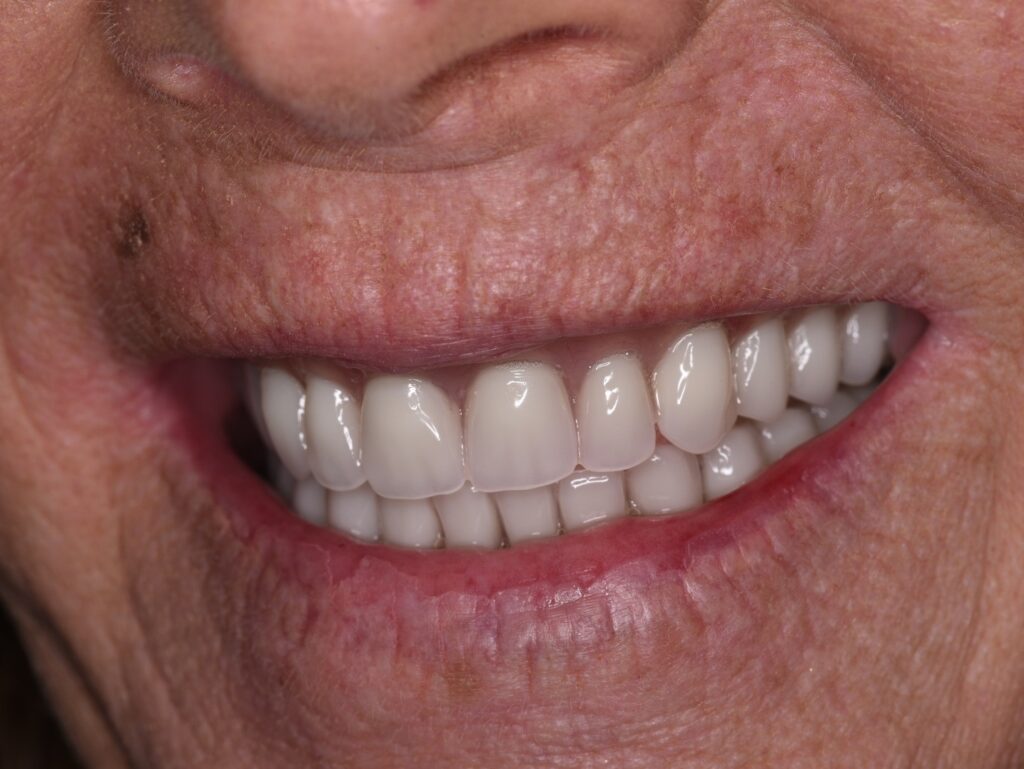 types of snap in dentures