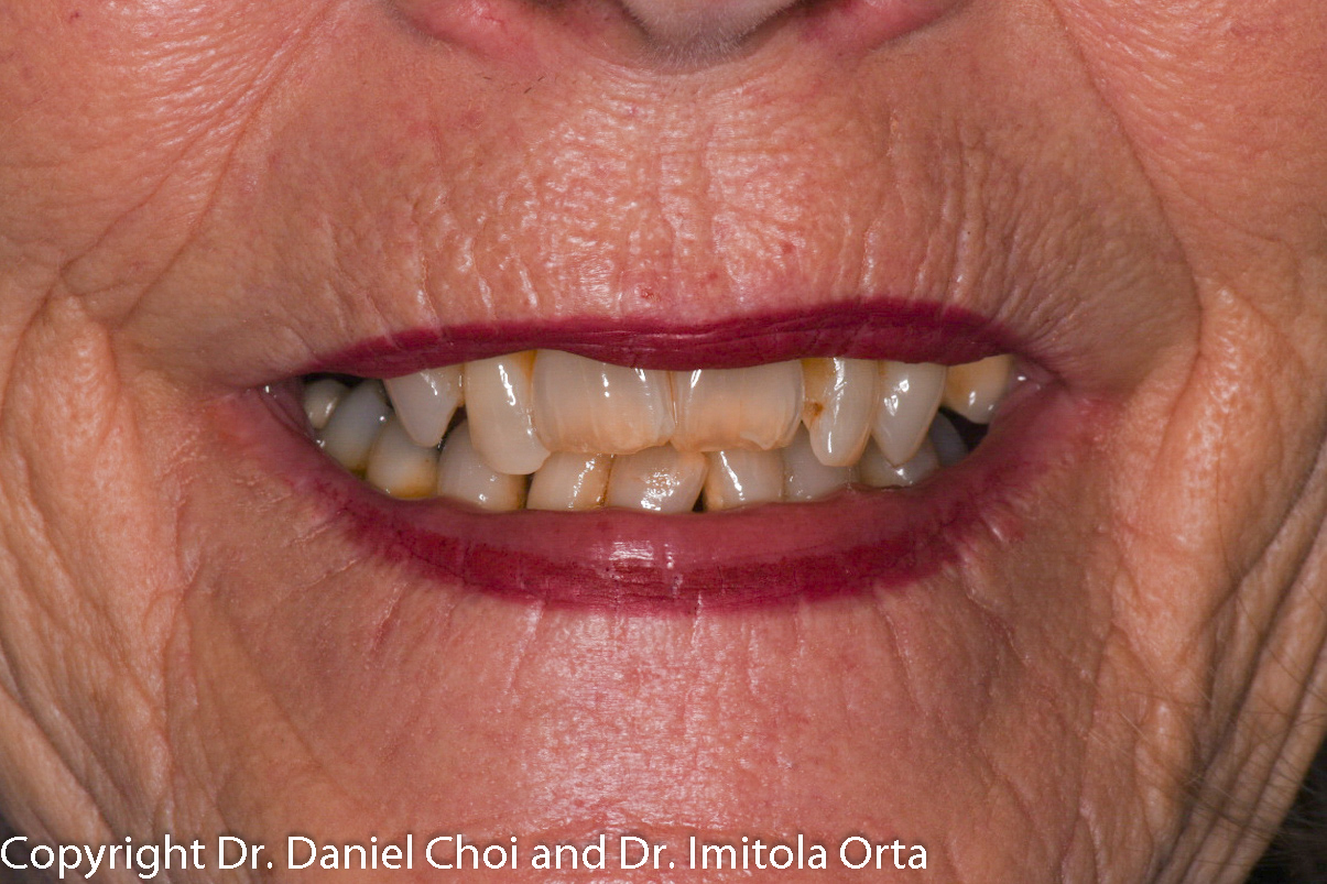 zirconia snap in dentures