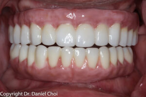 After Implant Dentures