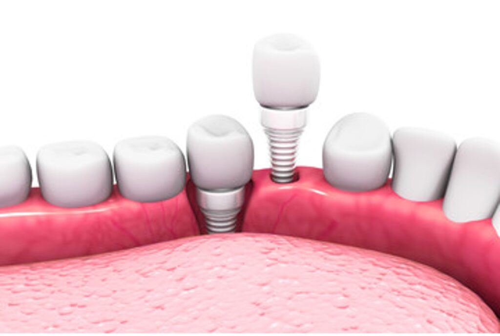 Zirconia Implants North Texas Dental Surgery