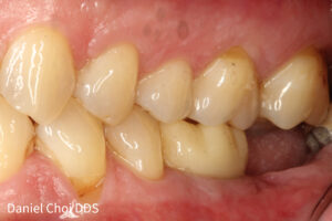 Dental implant before