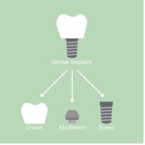 Sinus Lift and Dental Implant | North Texas Dental Surgery