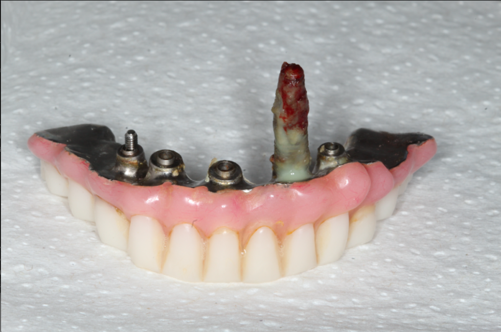 Infected Implant Denture