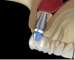 Sinus Lift and Dental Implant