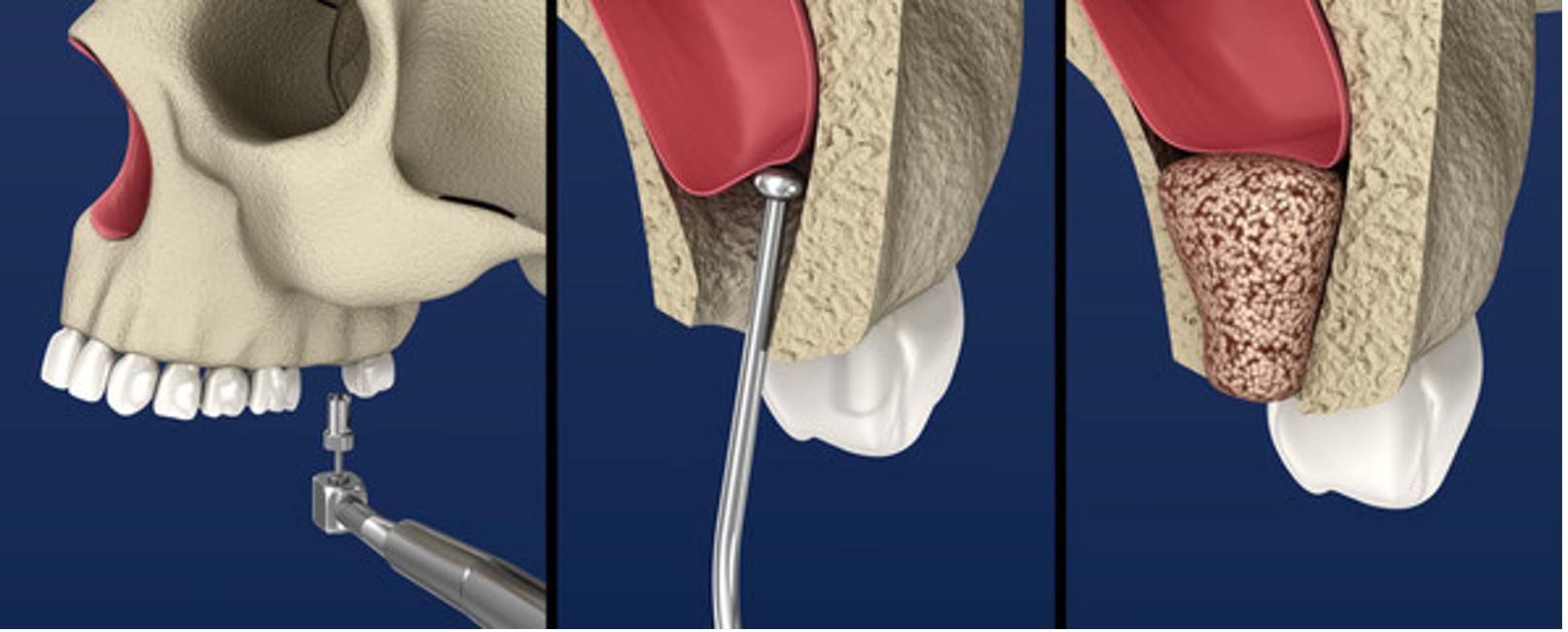 Sinus Lift And Dental Implant North Texas Dental Surgery