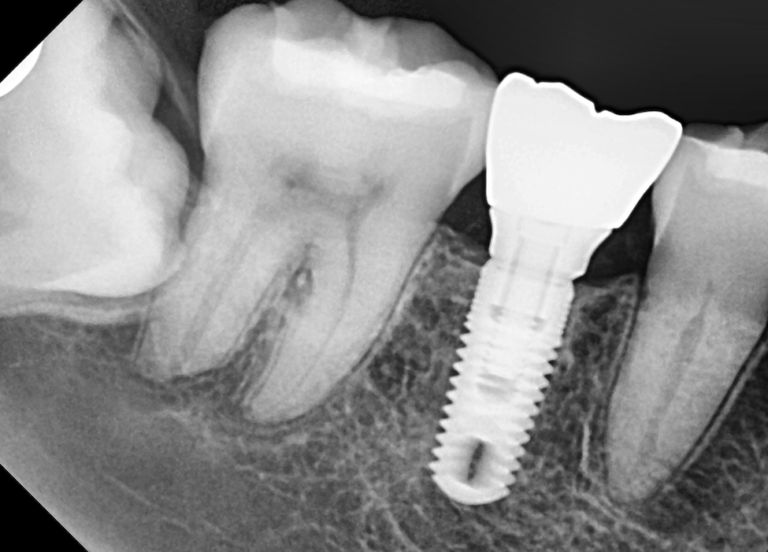 Zirconia Implants North Texas Dental Surgery