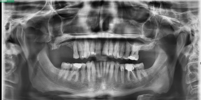 After Infected Root Canal