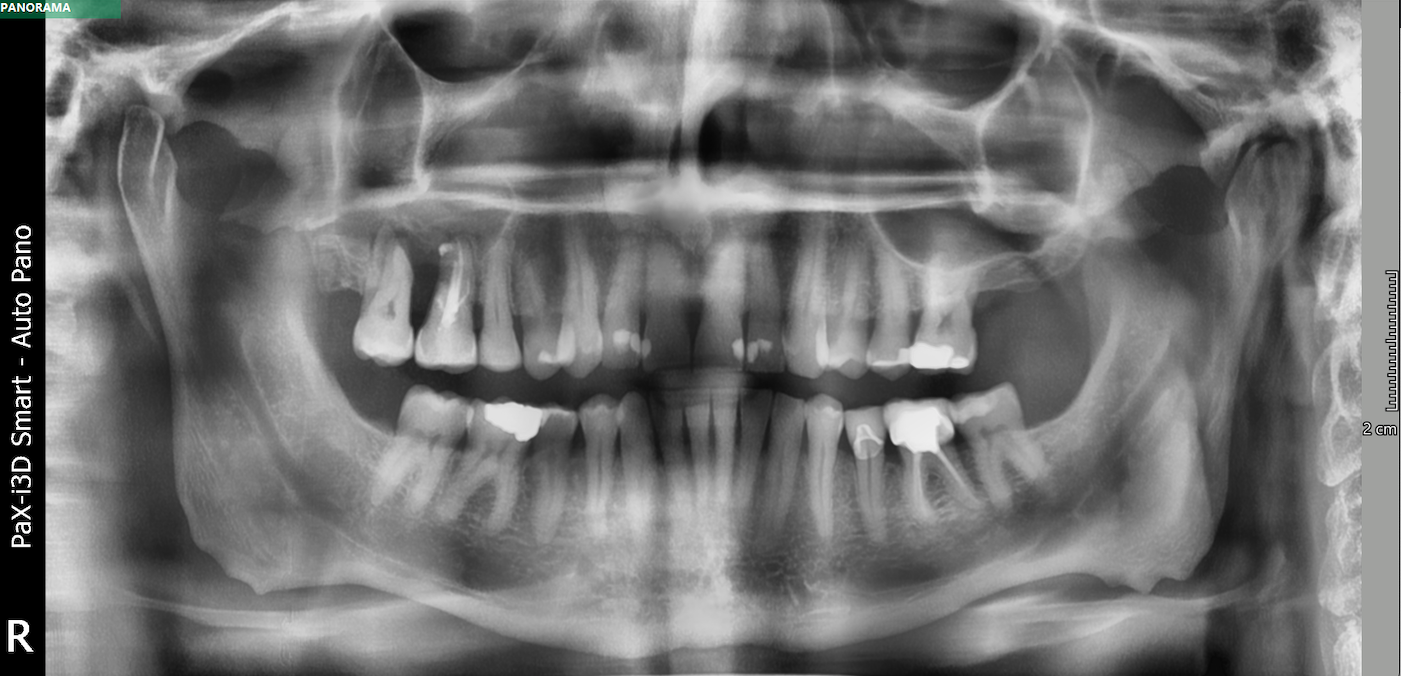 Infected Root Canal