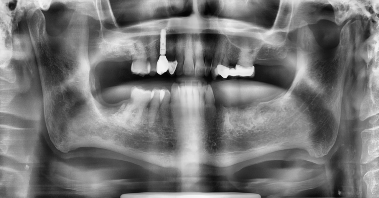 Before dental implants