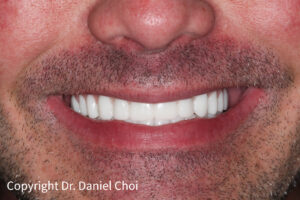 Denture Implants After