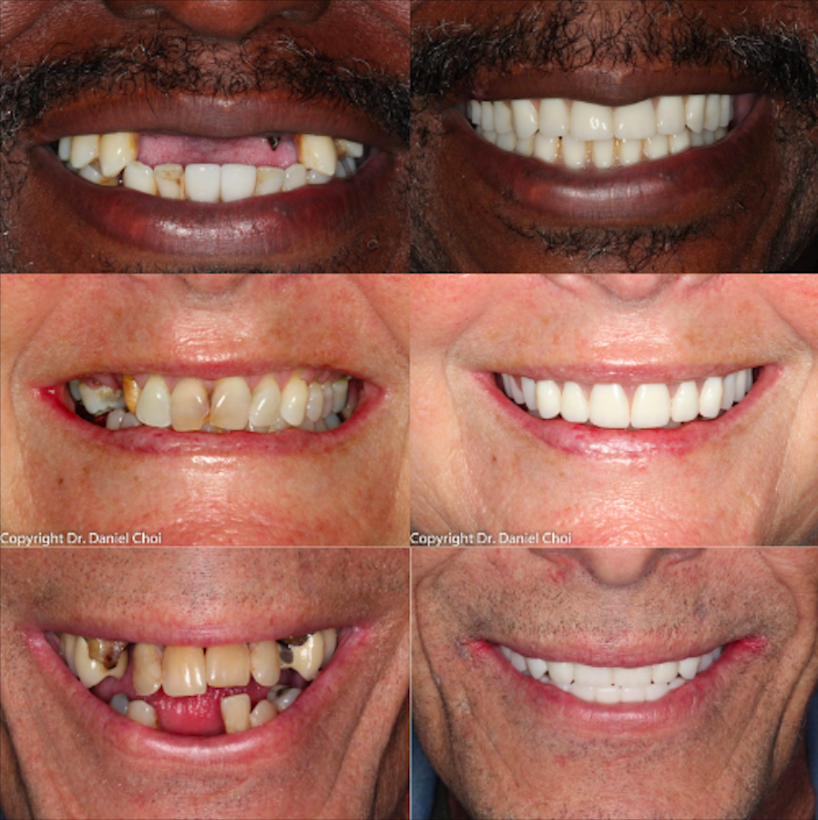 Snap On Dentures before and after