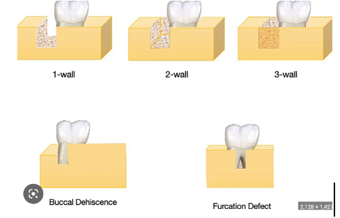 Dental Bone Defects
