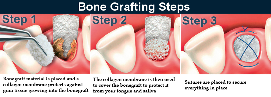 bone graft steps