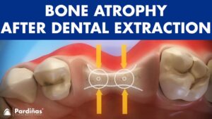 Bone Atrophy